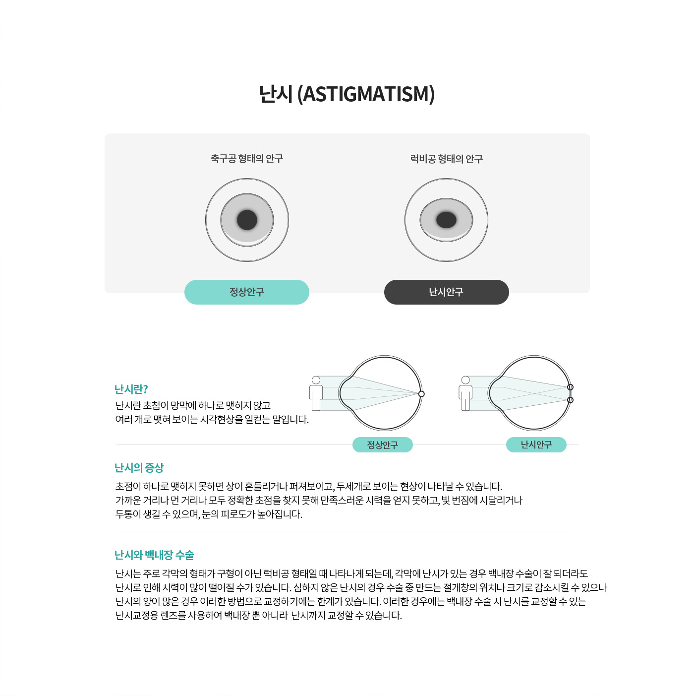 A. 난시 (Astigmatism)